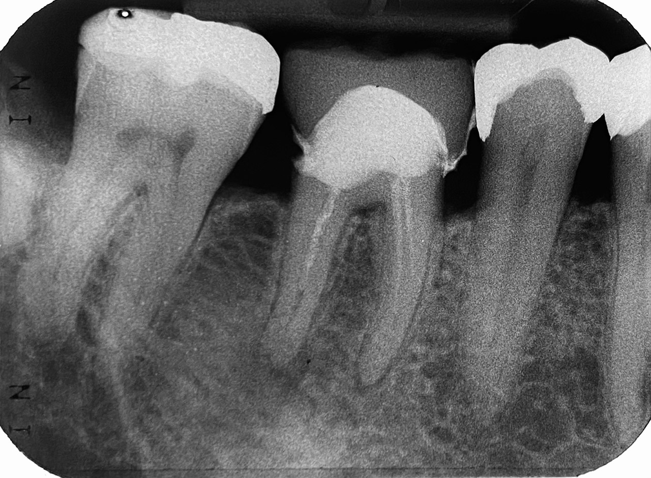 Endodontie/Wurzelbehandlung 01