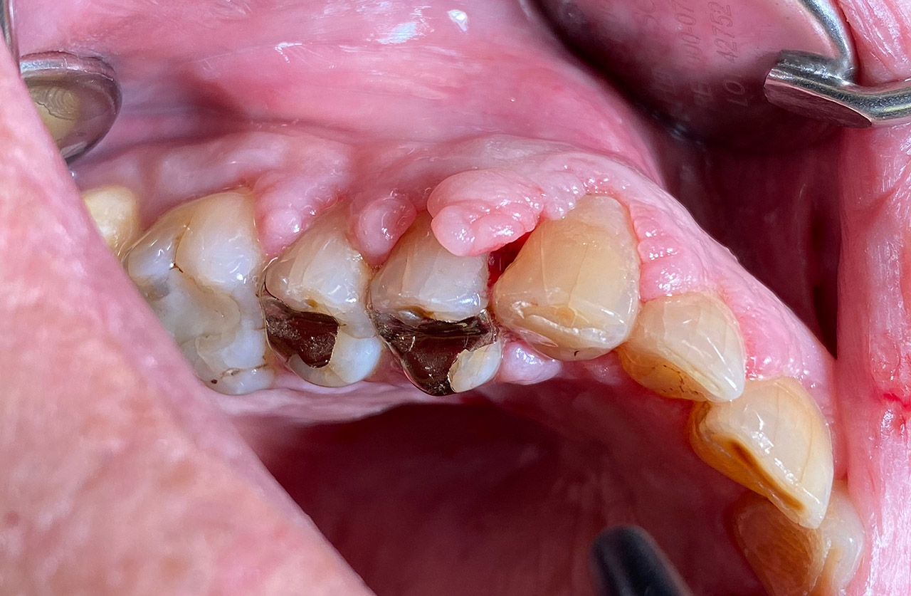 Parodontologie/Gingivahyperplasie 03