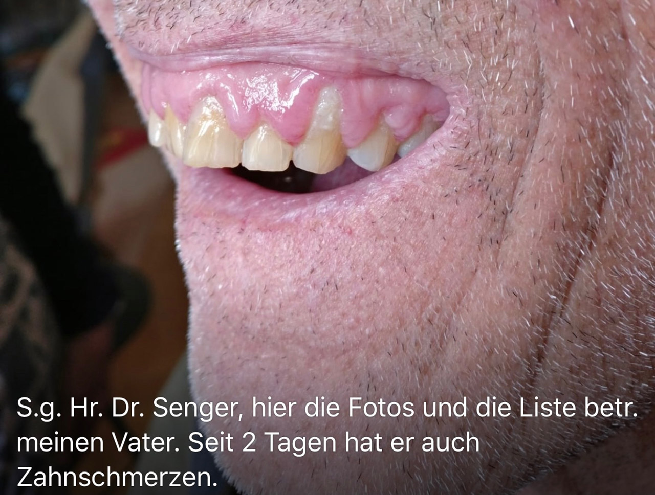 Parodontologie/Gingivahyperplasie 01