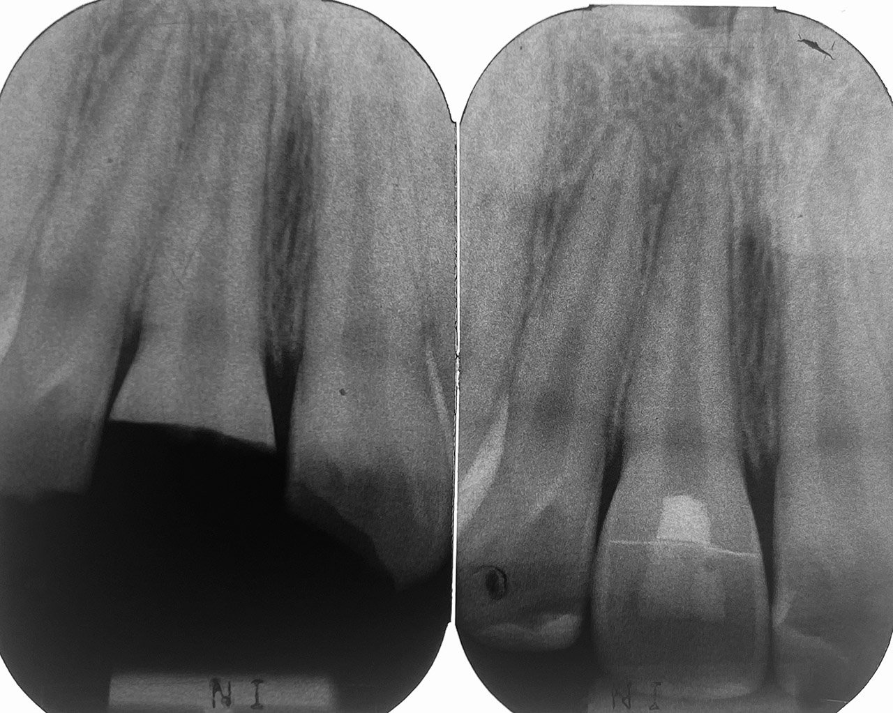 Traumatologie und Endodontie 09