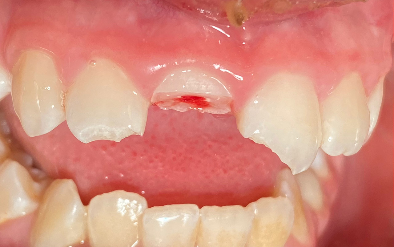 Traumatologie und Endodontie 01